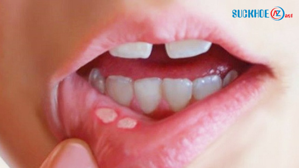 5 cách chữa nhiệt miệng
