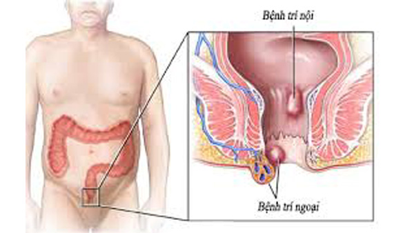 Nguyên nhân không ngờ gây bệnh trĩ