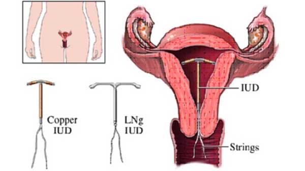 Đặt vòng tránh thai loại nào tốt cho chị em phụ nữ?