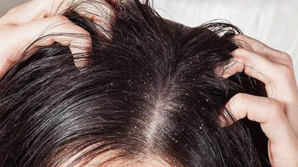 Lý do da đầu bị gàu thời điểm chuyển mùa