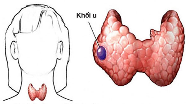 Những điều cần biết về u tuyến giáp