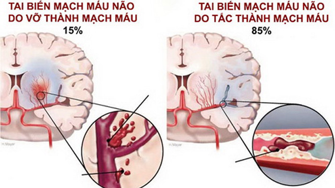 Tai biến mạch máu não: Cấp cứu thế nào để tránh tử vong?