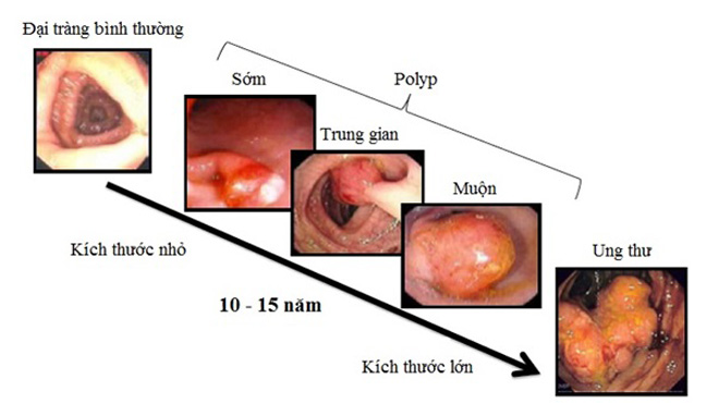 Phát hiện sớm ung thư đại trực tràng