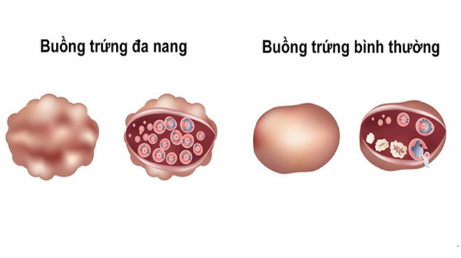 Tác hại do dậy thì sớm ở bé gái